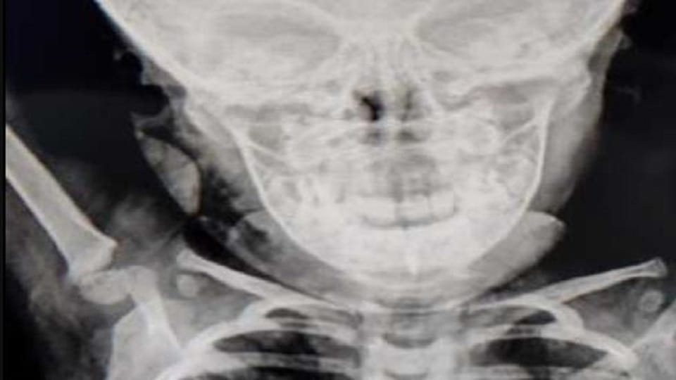 plaster crust got stuck in the child's windpipe this is how doctors saved his life