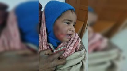 Dog Attack: Terror of stray dogs in Gwalior, deadly attack on a two-year-old child