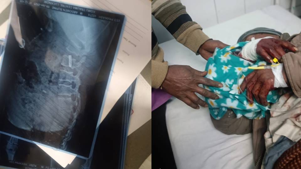 police got confused with theory of barbed wire while In Sitapur doctors removed bullet from stomach of injured