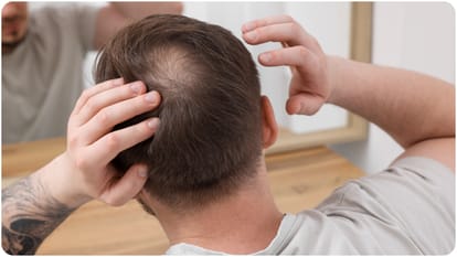 Mystery virus causes sudden hair loss infection know baldness virus Symptoms and Details in Hindi