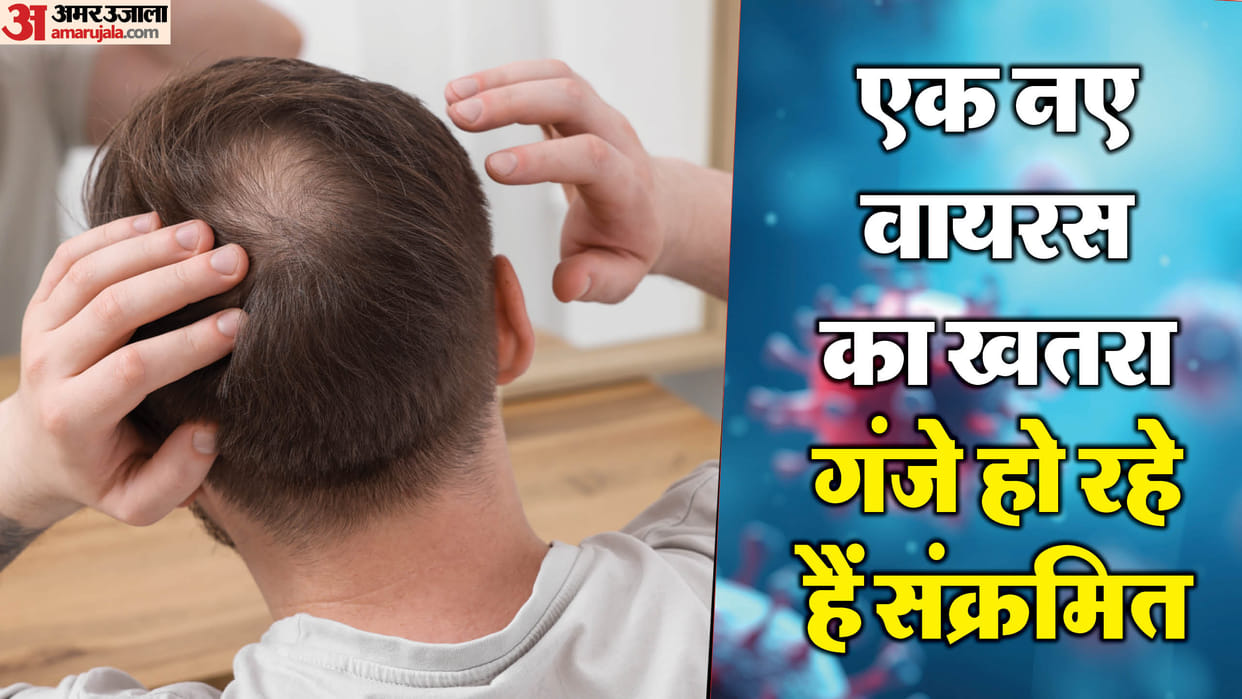 Mystery virus causes sudden hair loss infection know baldness virus Symptoms and Details in Hindi