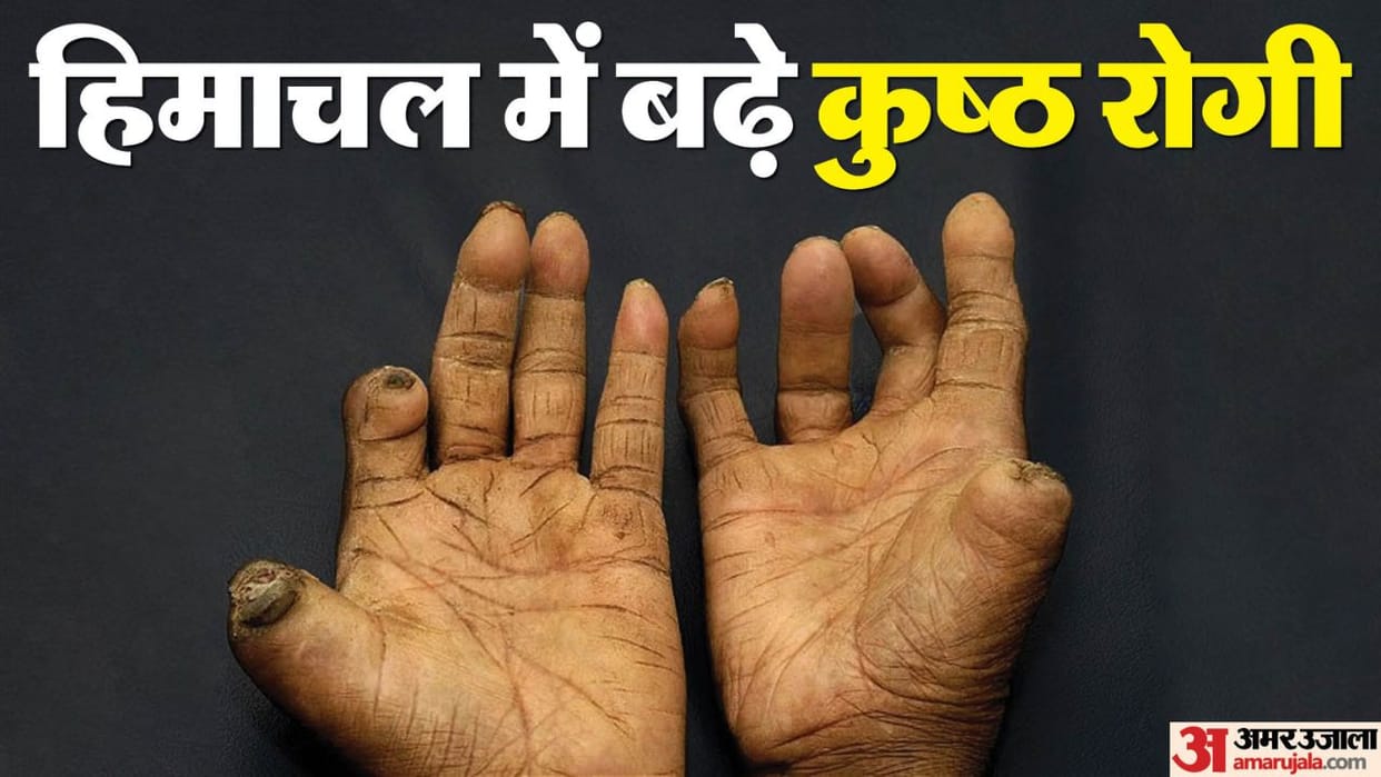 World Leprosy Day 2025 patients increased in Himachal Pradesh in three years 377 new cases
