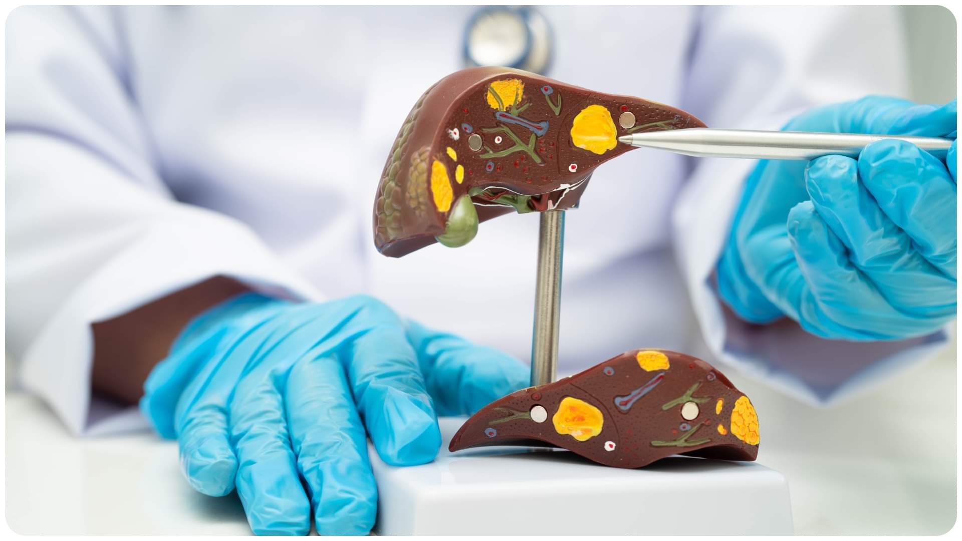 Yellow Eyes Warning Early Symptoms of Jaundice You Should Never Ignore