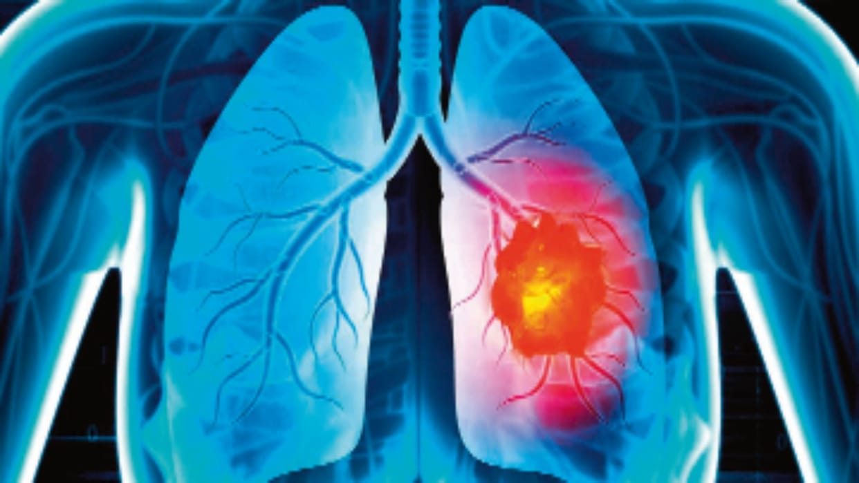 Air pollution is also causing lung cancer in non-smokers, study published in Lancet reveals News In Hindi