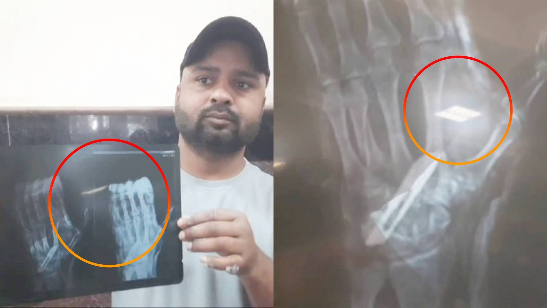 प्लास्टर के अंदर मिली ब्लेड