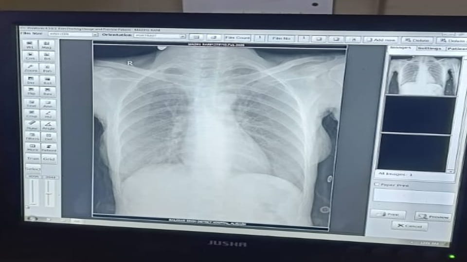 X-ray film finished in Aligarh District Hospital