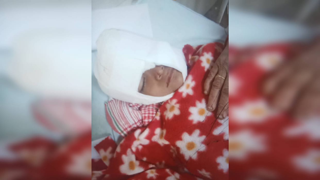 Dog Bite Terror of stray dogs in Gwalior flesh was torn and chewed from face of innocent life saved operation