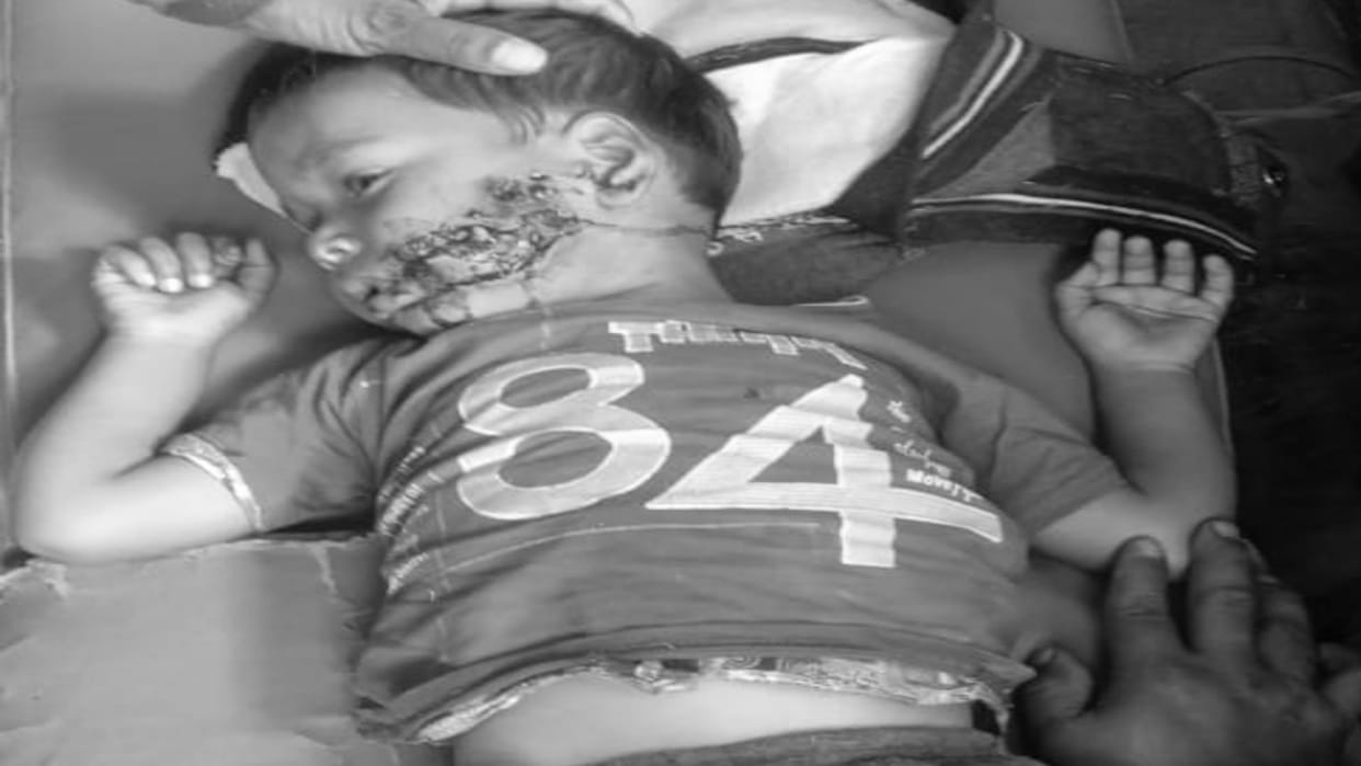 Stray dog attacks and injures two-year-old child in Bareilly