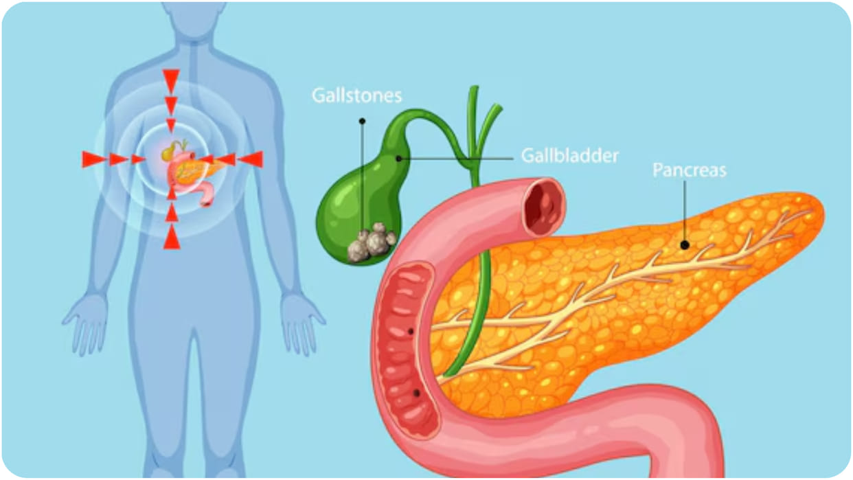 gallbladder stone causes symptoms and prevention tips know gallbladder stone se kaise bache