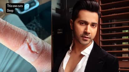 Varun Dhawan got injured during the shooting of Border 2 shared the photo said this one cuts deep