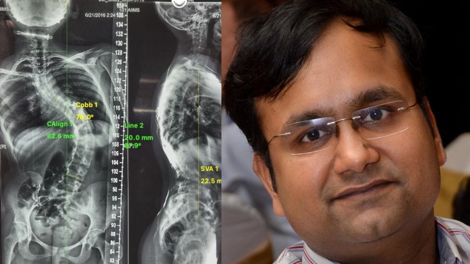 Spine experts develop new technique to treat congenital scoliosis