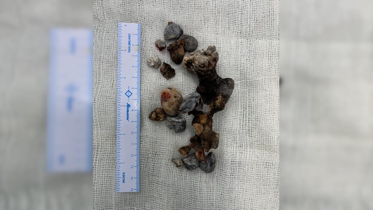 SRN doctors claim - World's largest stone removed from kidney