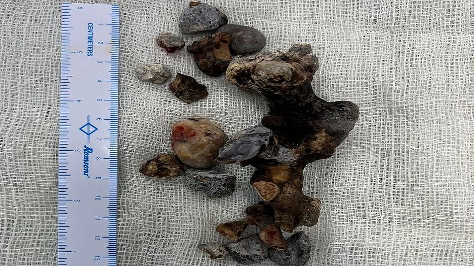 World largest kidney stone removed at SRN in prayagraj