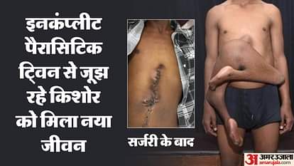 डॉक्टरों का चमत्कार: चार पैर वाले किशोर की सर्जरी कर दिया जीवन, दुनियाभर में इस तरह के अब तक आए सिर्फ 40 मामले Delhi AIIMS doctors performed surgery on a four legged teen and gave him new life