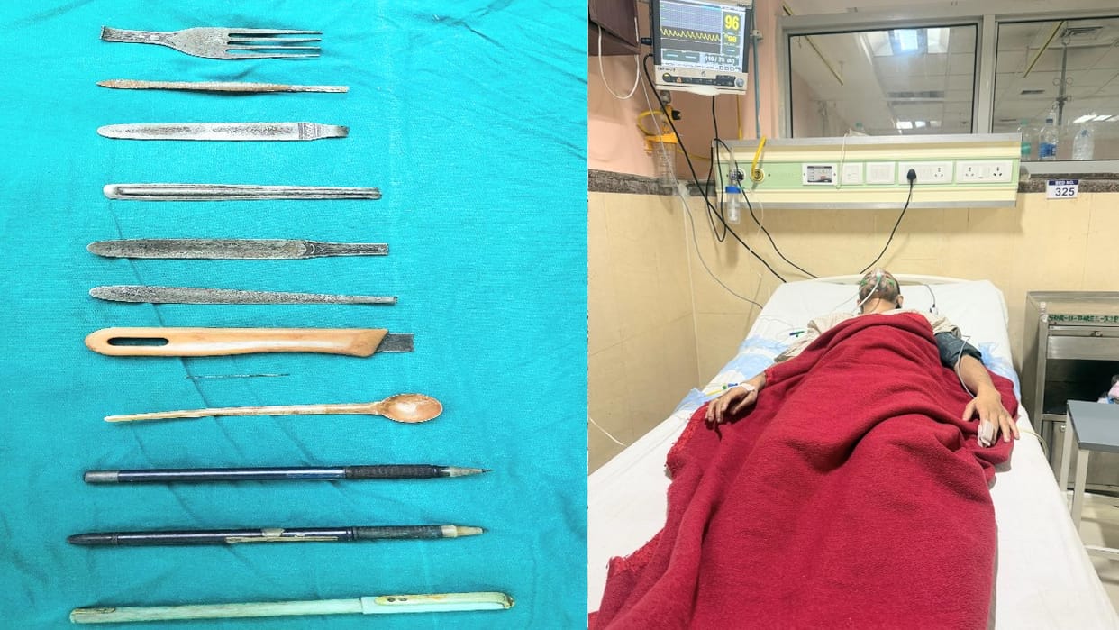 Doctors removed knives, forks and pens from the stomach of a mentally retarded person through surgery