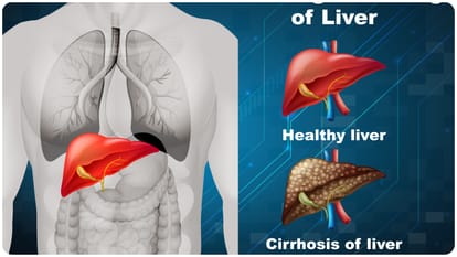Lancet study says liver cancer may rise 55 percent by 2040 hepatitis and alcohol habits increasing risk