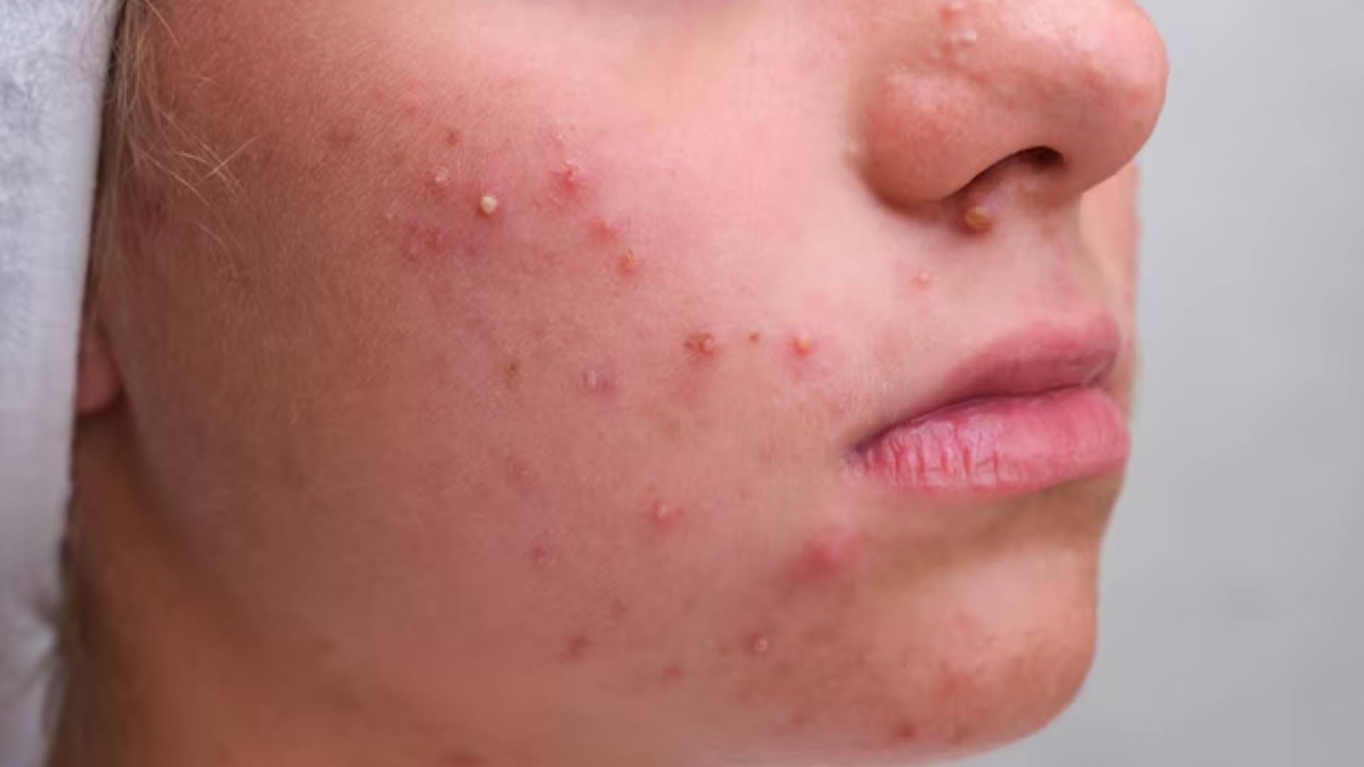 Side Effect Of Removing Acne: Is it right to pop pimples Know the truth otherwise problems may increase