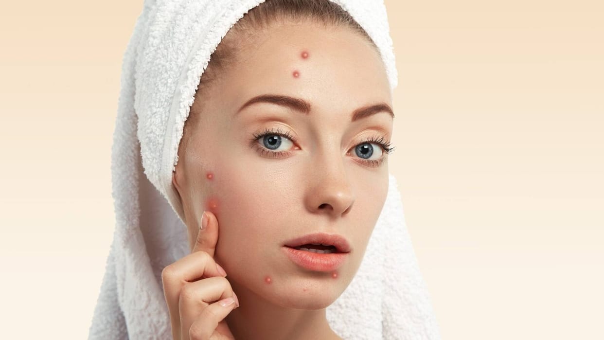Side Effect Of Removing Acne: Is it right to pop pimples Know the truth otherwise problems may increase