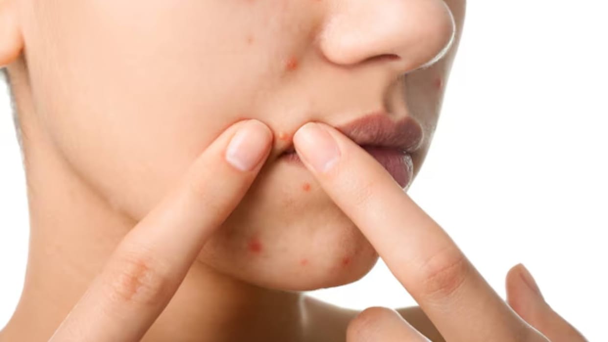 Mental stress can be the cause of acne, psoriasis, hair loss