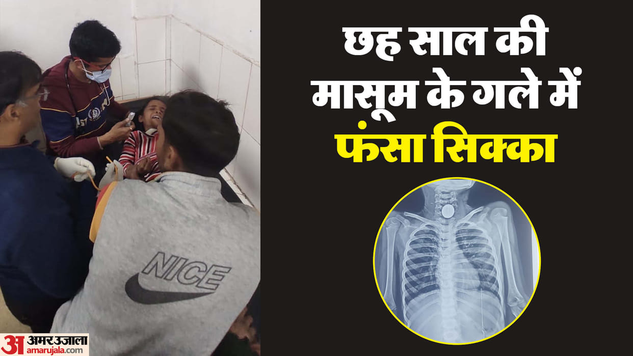 five rupee coin got stuck in the throat of girl while playing in Bareilly