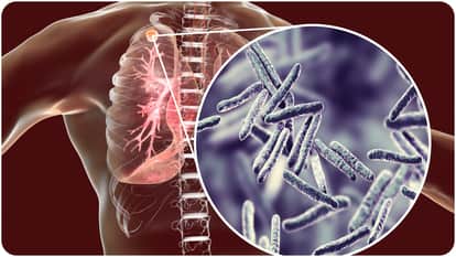 ICMR to Launch Nationwide High-Dose Drug Therapy Trial to Speed Up TB Treatment in India