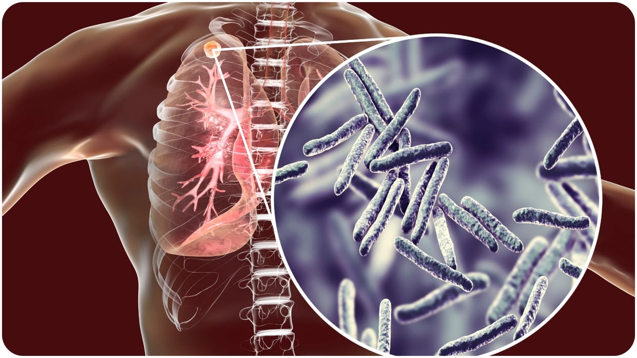 As soon as surveillance increased in UP, TB patients were found 16 times in seven years