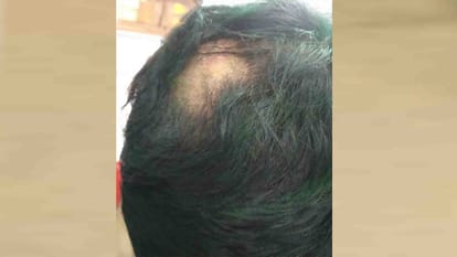 केमिकल वाला रंग पड़ते ही उड़े बाल