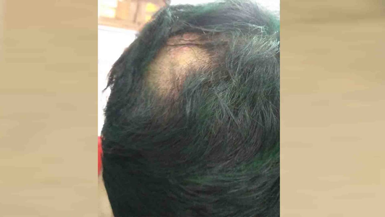 Eye corneas damaged due to colours, hair on head disappeared, skin allergy increased due to chemicals