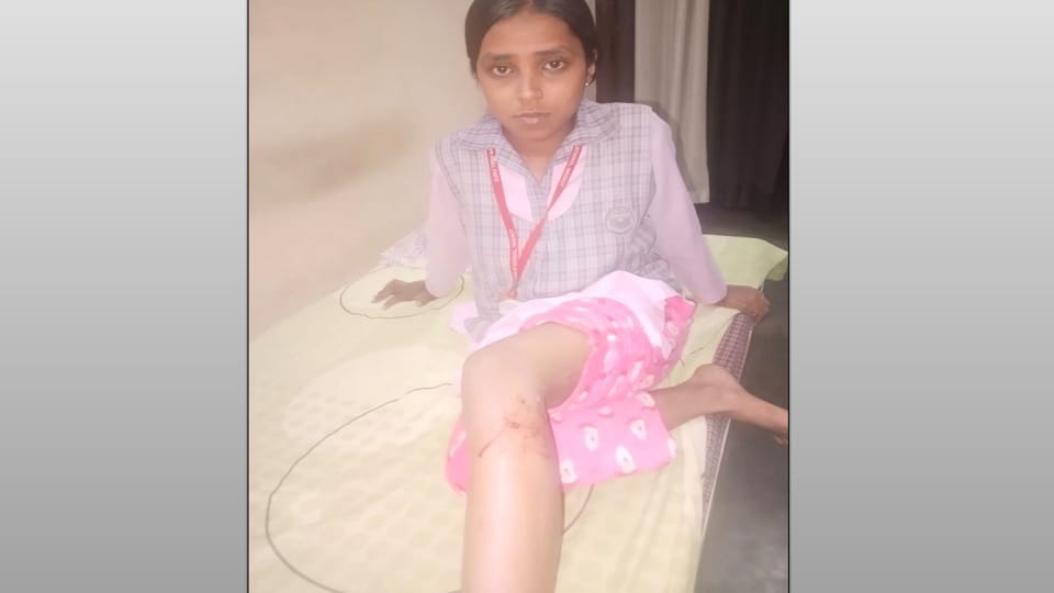 Meerut: A student going to give her paper was attacked by dogs in Indiranagar, they kept scratching her leg