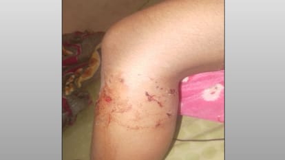 Meerut: A student going to give her paper was attacked by dogs in Indiranagar, they kept scratching her leg