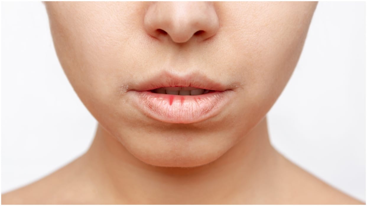 Dry Lips in Winter Try These Easy Home Remedies to Keep Soft and hydrated