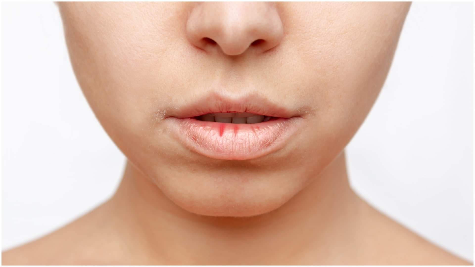 Dry Lips in Winter Try These Easy Home Remedies to Keep Soft and hydrated