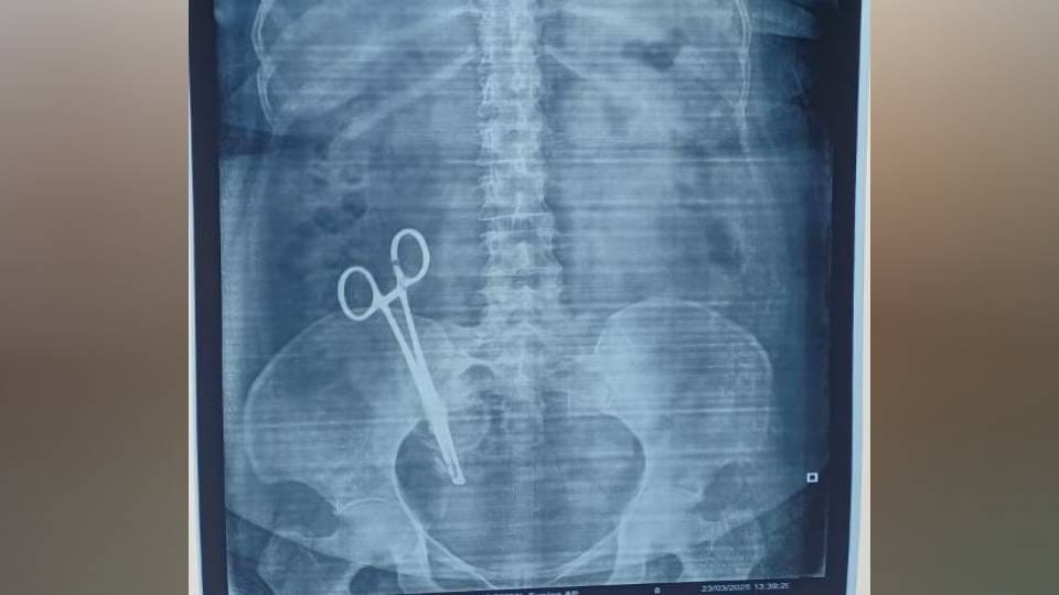 doctor of private hospital left scissors in stomach of women In Lucknow truth revealed when done X-ray