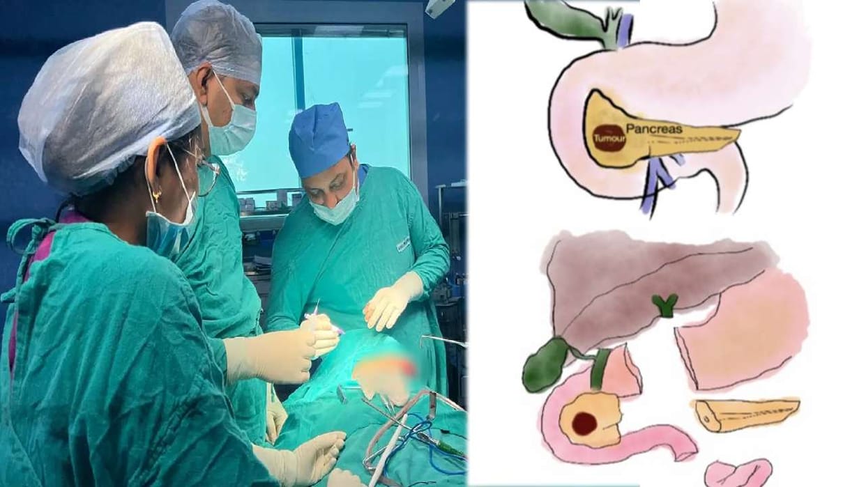 AIIMS saved life of girl child by performing a rare keyhole surgery