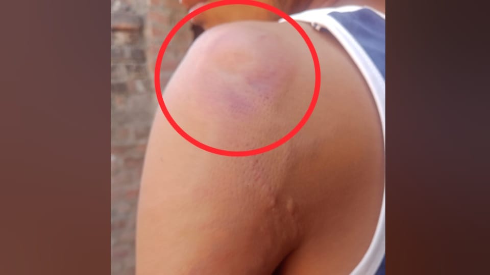 SC student alleges teacher He broke his fingers when he drank water from teacher bottle in mainpuri