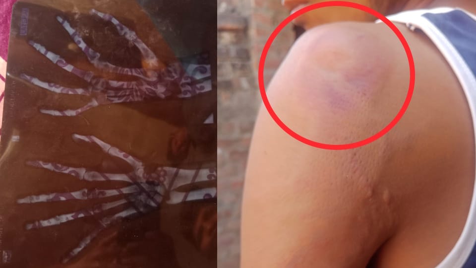 SC student alleges teacher He broke his fingers when he drank water from teacher bottle in mainpuri