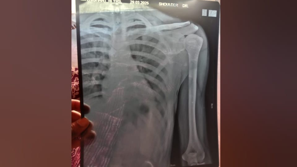 SC student alleges teacher He broke his fingers when he drank water from teacher bottle in mainpuri
