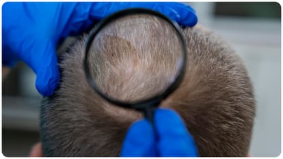 treatment for baldness and hair loss study identified MCL‑1 protein essential for hair growth