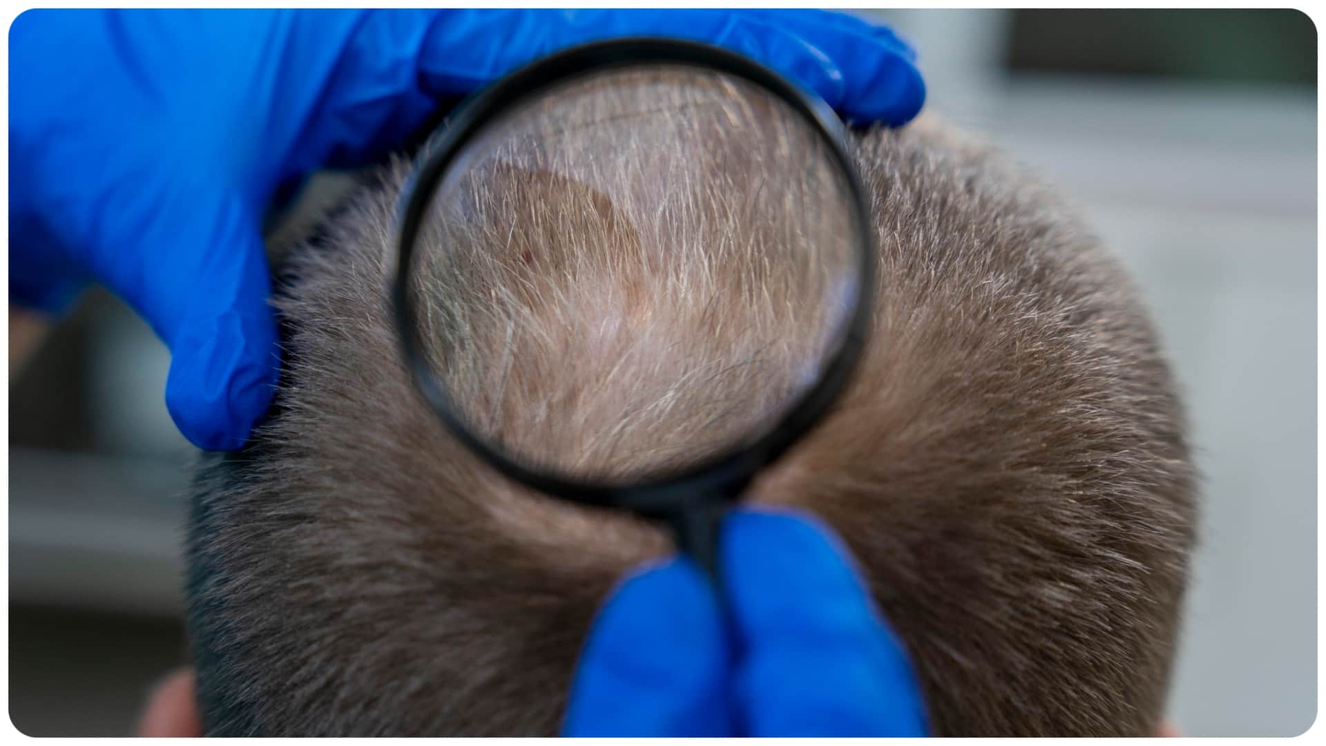 why my hair is falling so much poor gut health may cause hair loss among Indian men