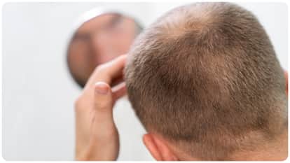 arthritis and Crohn disease medicine Upadacitinib could reverse hair loss in alopecia areata