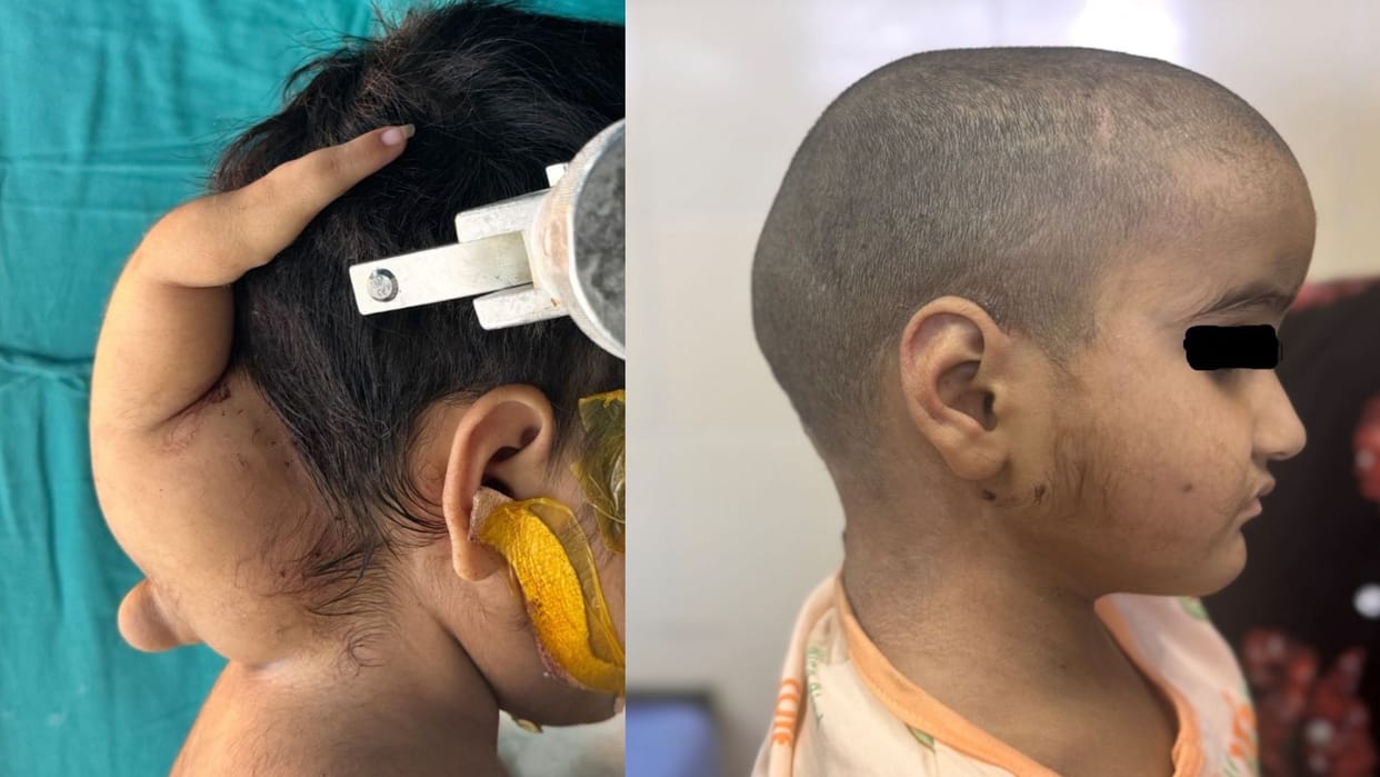 MP News: Complex surgery of a three-year-old girl in Bhopal AIIMS, doctors removed the parasitic twin part
