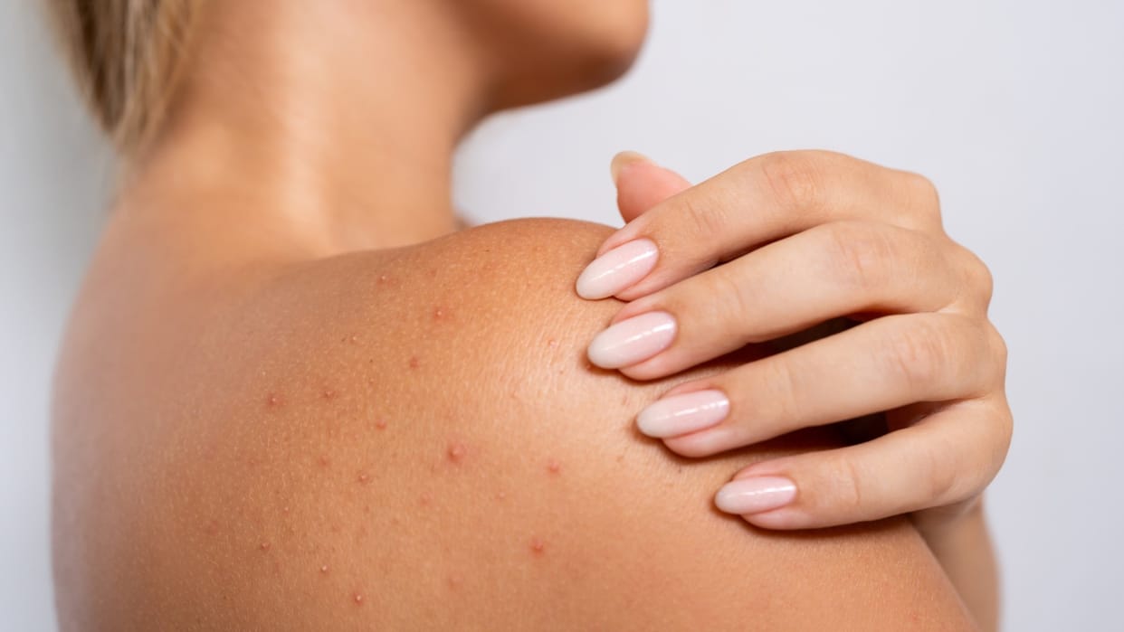Effective Natural Remedies to Treat Heat Pimples in hindi