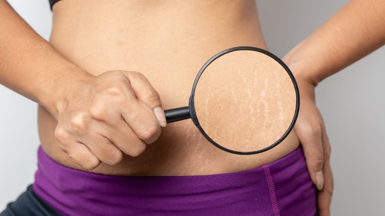 How to remove stretch marks in hindi strech marks hatane ke upay