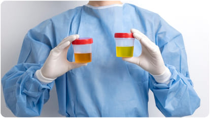 What color of urine is worrying know urine colour and health status in hindi