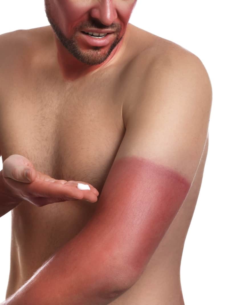 Summer Skincare Tips Home Remedies For Sun Tan Removal In Hindi