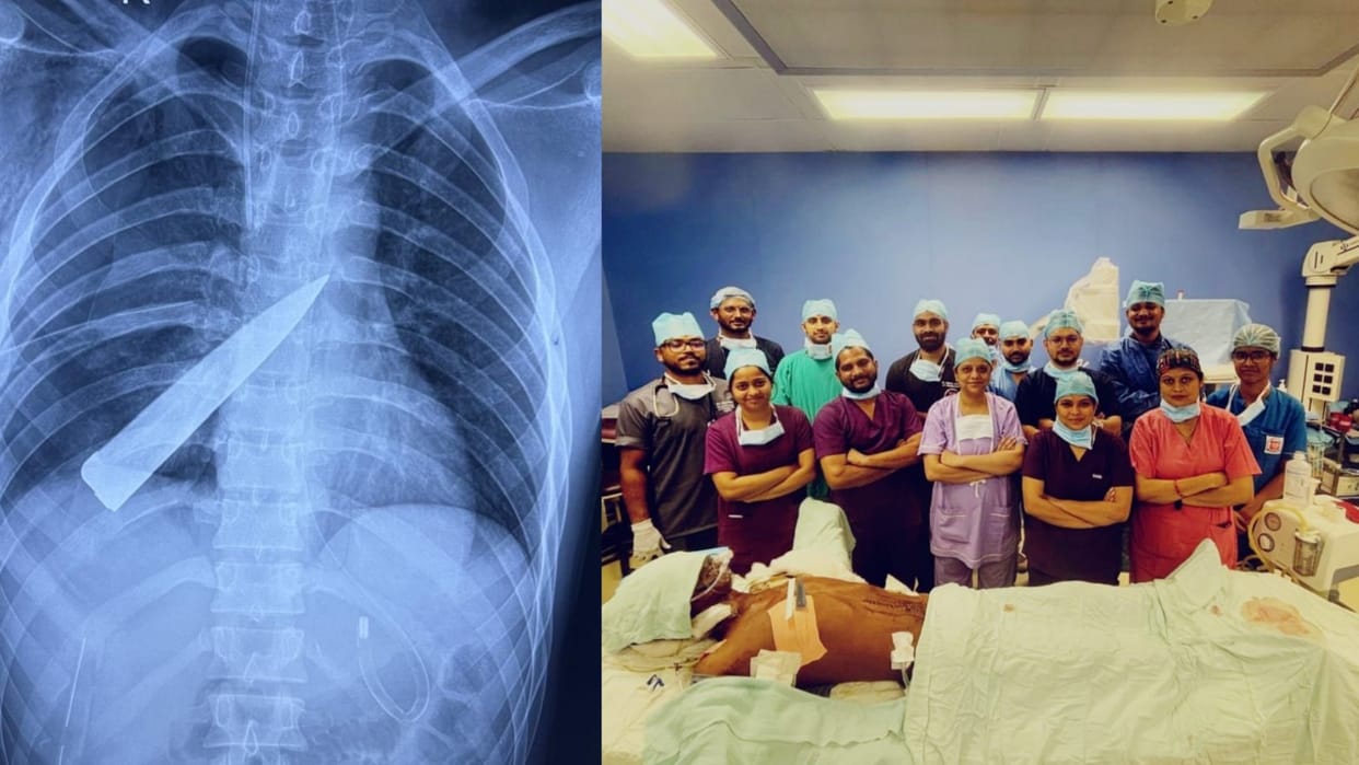 Knife broke in the chest, hope did not break Doctors took it out through surgery he involved in a fight
