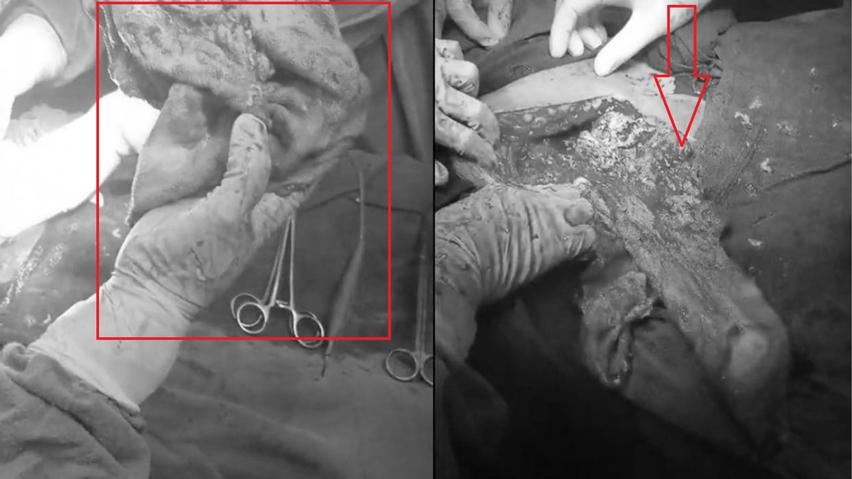 After one and a half years a cloth removed from stomach of woman
