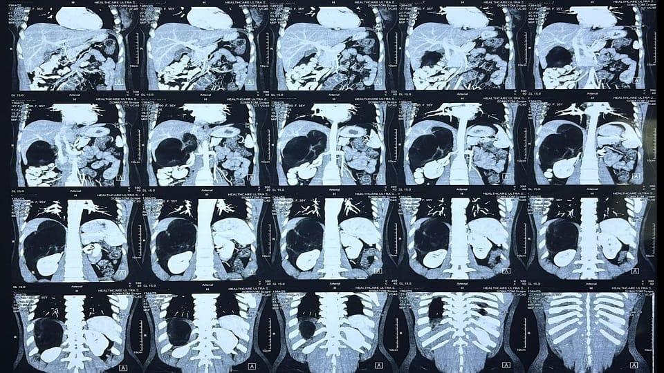 Doctors at Safdarjung Hospital removed the world largest tumor from a woman stomach