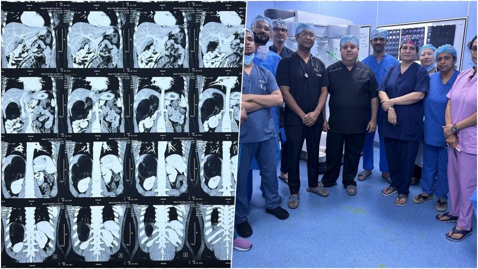 Doctors at Safdarjung Hospital removed the world's largest tumor from the stomach through robotic surgery