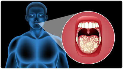 Oral Cancer Alarm in India: Tobacco and Alcohol Behind 62% Cases, Study Reveals